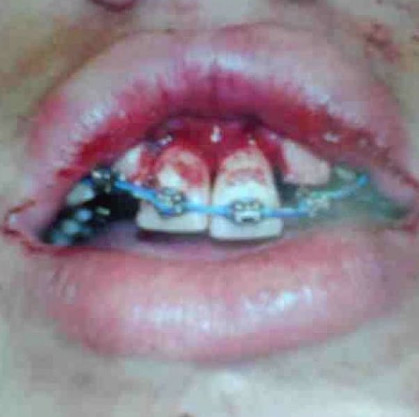 man with braces mouth trauma after sports accident