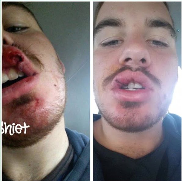 man with busted lip trauma from sports