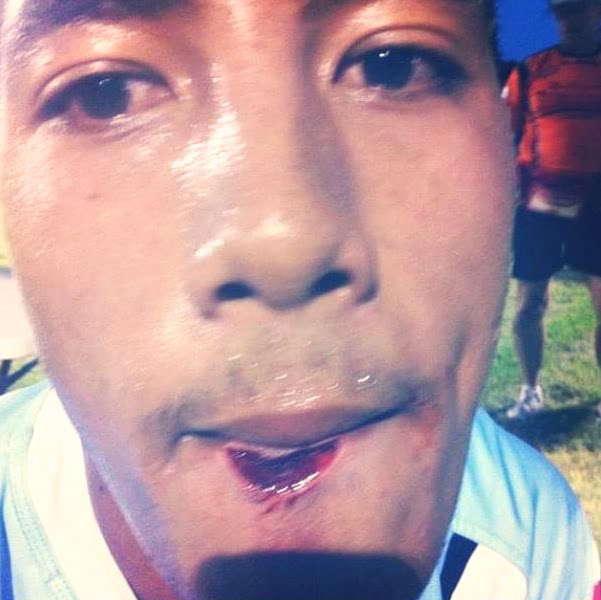 tooth punctured through lip after football accident 