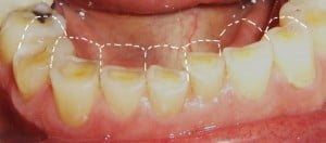 bruxism: severe case of teeth regression loss of tooth structure