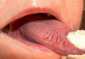 damage from tongue biting