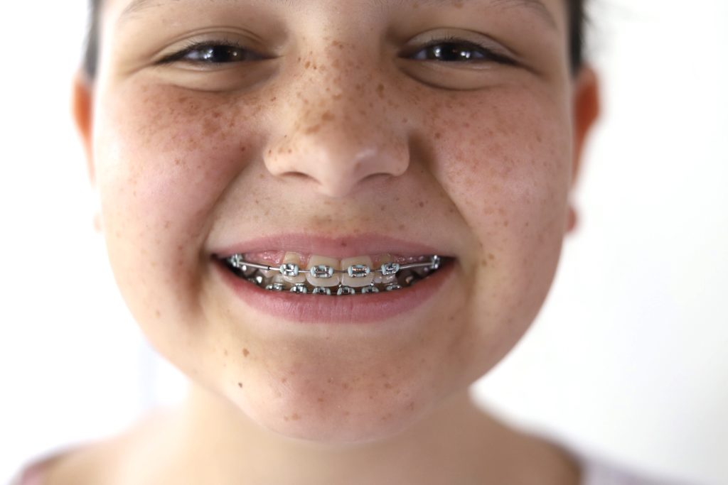 traditional braces compared to clear aligners