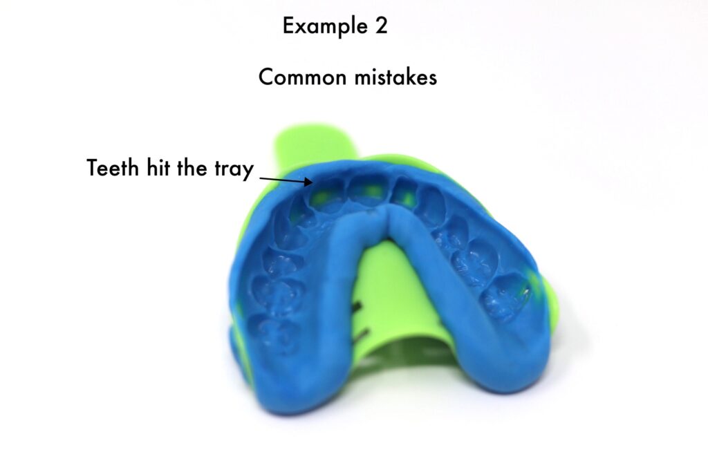 dental impression common mistakes example 2