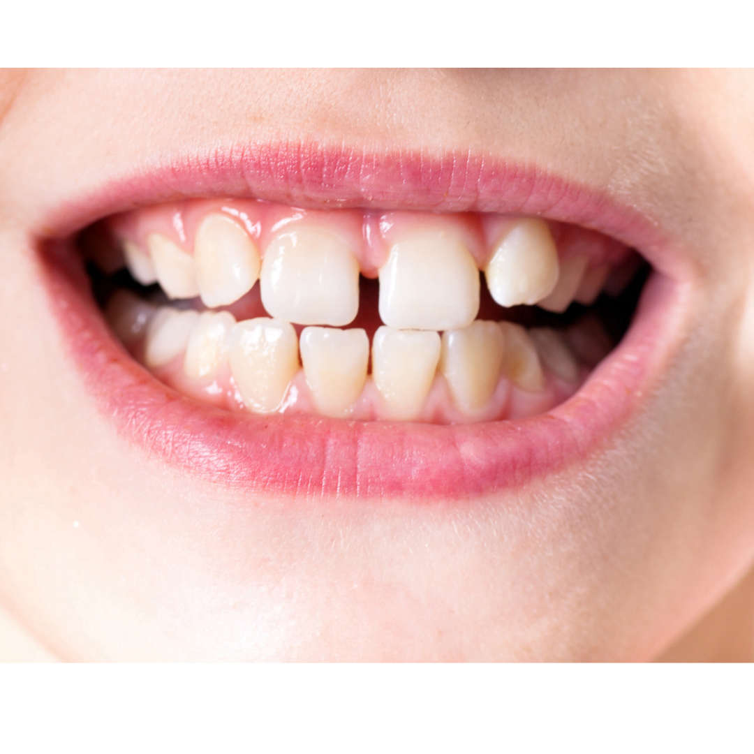 What Age Can a Child Wear a Dental Night Guard? Sentinel Mouthguards®