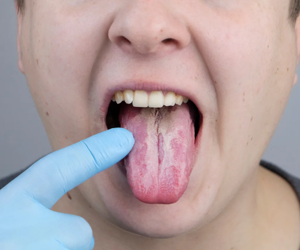 I-Bite-My-Tongue-Risks-Prevention-Treatm
