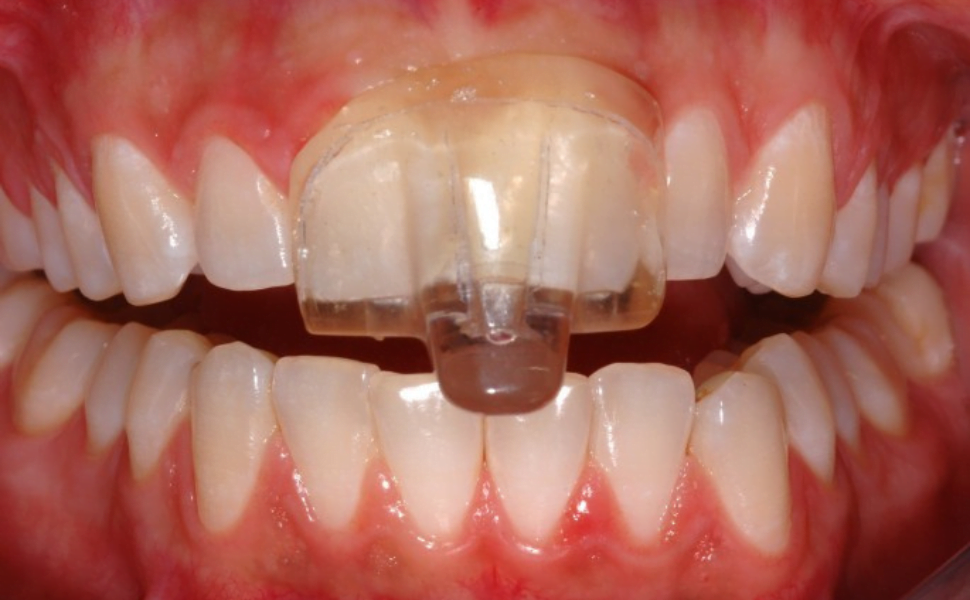nti-tss device used for teeth grinding and jaw clenching relief
