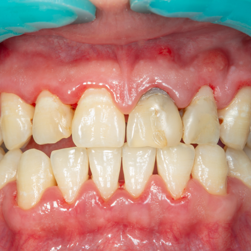 Teeth Stains vs Enamel Erosion | What’s The Difference? | Sentinel ...