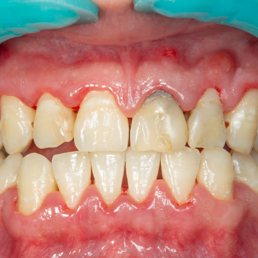 Teeth Stains Vs Enamel Erosion Whats The Difference Sentinel