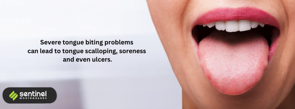 Bite Your Tongue During Sleep Heres What To Do Sentinel Mouthguards®