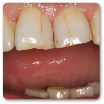 craze lines in teeth from grinding and clenching