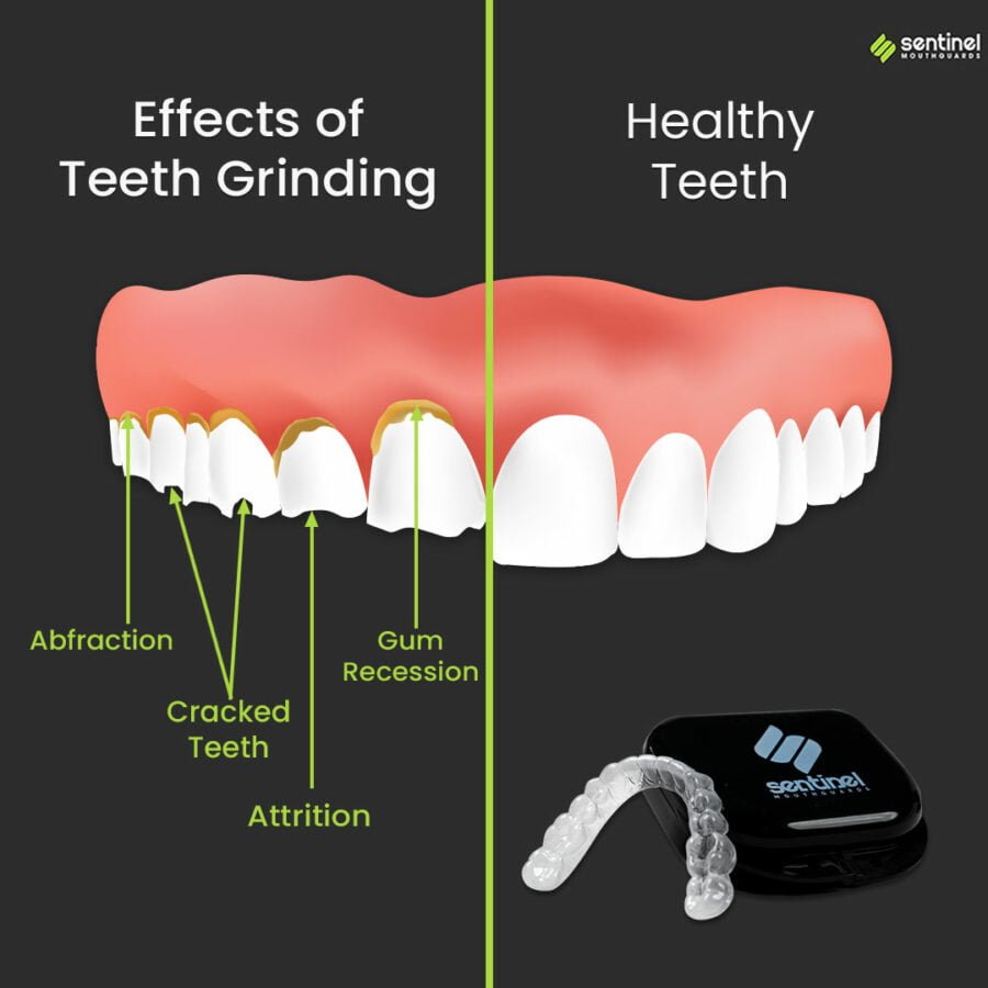 sentinel mouthguards flat teeth from grinding graphic