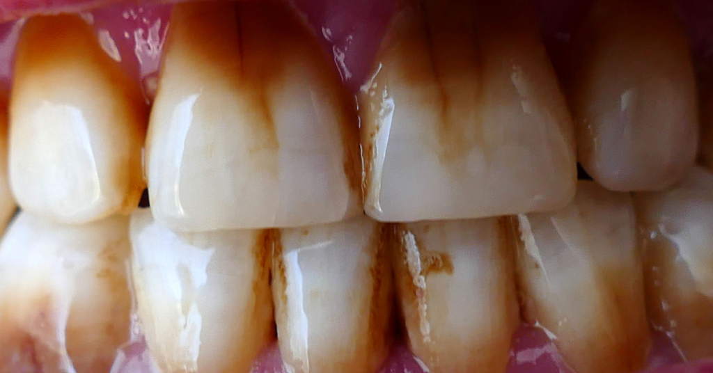 extrinsic surface teeth stains