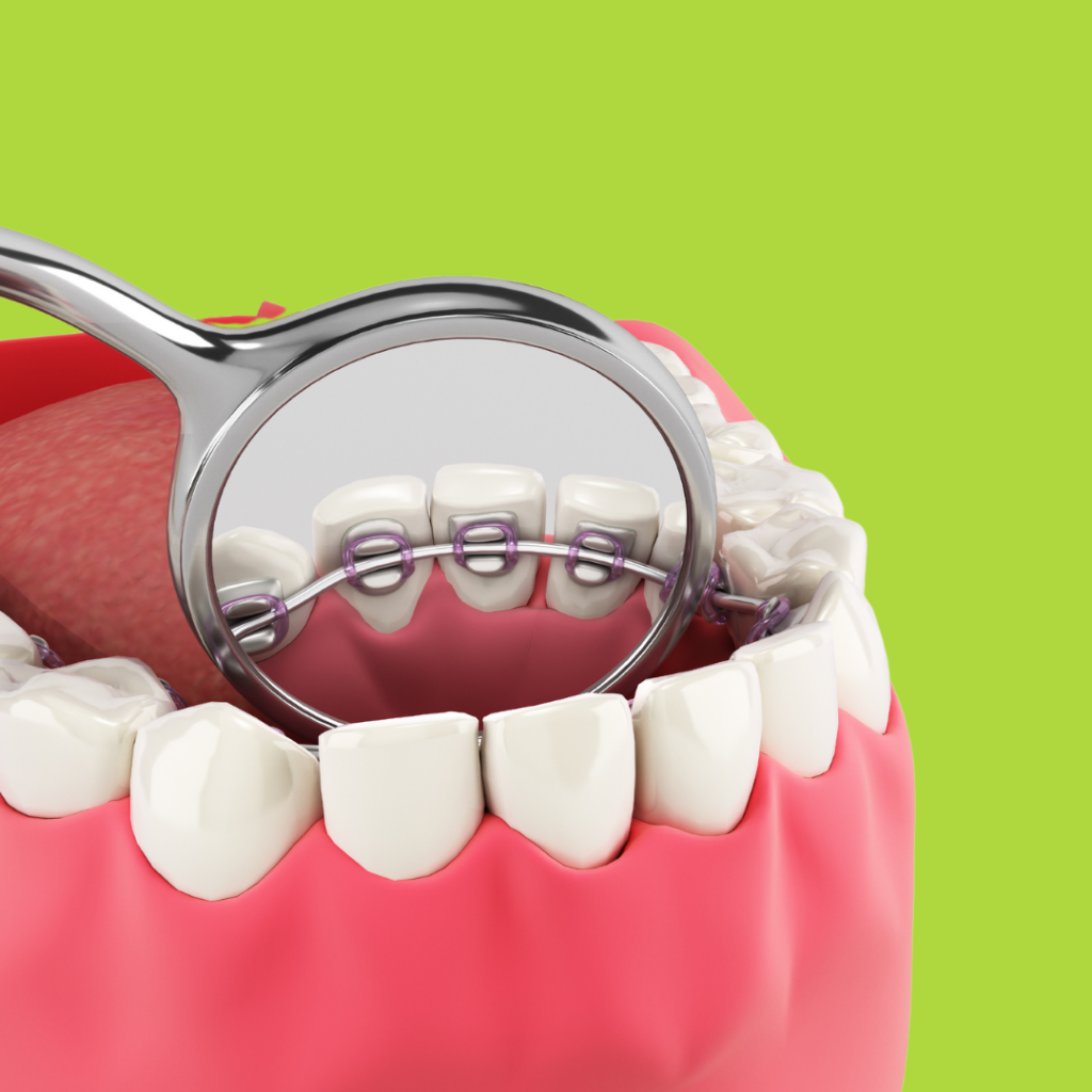 permanent bar or lingual retainer to keep teeth from shifting